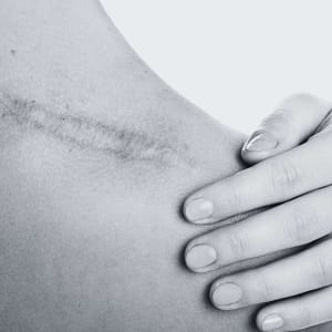 Woman showing her shoulder scar